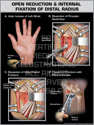 Exhibit of Open Reduction & Internal Fixation of Distal Radius.