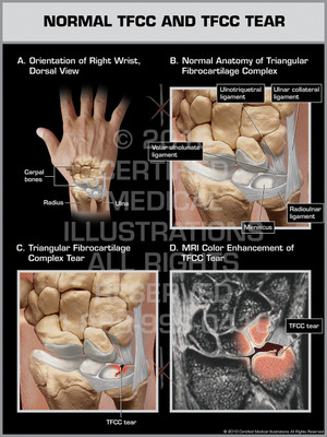Exhibit of Normal TFCC and TFCC Tear. Exhibit of Normal TFCC and TFCC Tear.