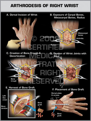 Exhibit of Arthrodesis of Right Wrist. Exhibit of Arthrodesis of Right Wrist.