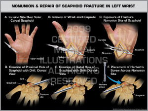 Exhibit of Nonunion & Repair of Scaphoid Fracture in Left Wrist 1. Exhibit of Nonunion & Repair of Scaphoid Fracture in Left Wrist 1.