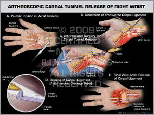 Exhibit of Arthroscopic Carpal Tunnel Release of Right Wrist.