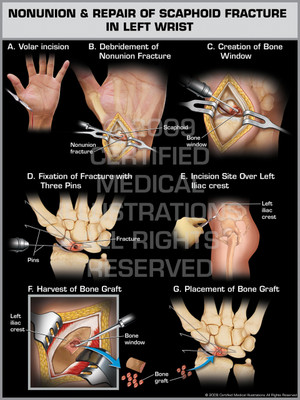 Exhibit of Nonunion & Repair of Scaphoid Fracture in Left Wrist.