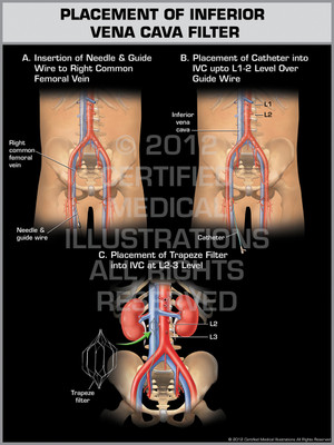 Exhibit of Placement of Inferior Vena Cava Filter. Exhibit of Placement of Inferior Vena Cava Filter.