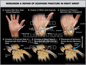Exhibit of Nonunion & Repair of Scaphoid Fracture in Right Wrist.