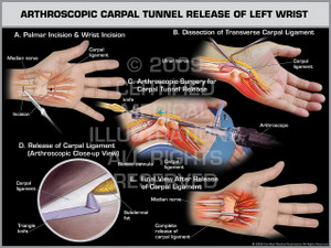 Exhibit of Arthroscopic Carpal Tunnel Release of Left Wrist.