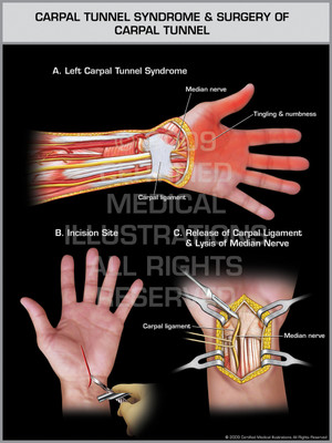 Exhibit of Carpal Tunnel Syndrome & Surgery of Carpal Tunnel - Left Hand.