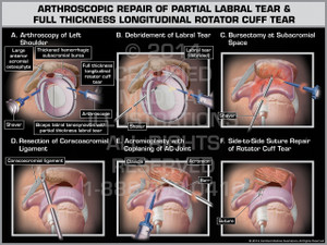 Exhibit of Arthroscopic Repair of Partial Labral Tear & Full Thickness Longitudinal Rotator Cuff Tear. Exhibit of Arthroscopic Repair of Partial Labral Tear & Full Thickness Longitudinal Rotator Cuff Tear.
