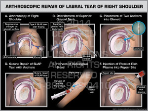 Exhibit of Arthroscopic Repair of Labral Tear of Right Shoulder.