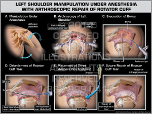 Exhibit of Left Shoulder Manipulation Under Anesthesia with Arthroscopic Repair of Rotator Cuff. Exhibit of Left Shoulder Manipulation Under Anesthesia with Arthroscopic Repair of Rotator Cuff.