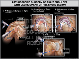Exhibit of Arthroscopic Surgery of Right Shoulder with Debridement of Hill-Sachs Lesion. Exhibit of Arthroscopic Surgery of Right Shoulder with Debridement of Hill-Sachs Lesion.