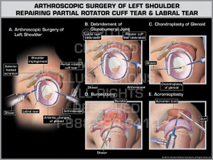 Exhibit of Arthroscopic Surgery of Left Shoulder Repairing Partial Rotator Cuff Tear & Labral Tear. Exhibit of Arthroscopic Surgery of Left Shoulder Repairing Partial Rotator Cuff Tear & Labral Tear.