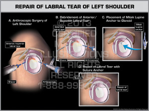 Exhibit of Repair of Labral Tear of Left Shoulder. Exhibit of Repair of Labral Tear of Left Shoulder.
