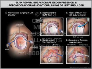Exhibit of Slap Repair, Subacromial Decompression & Acromioclavicular Joint Coplaning of Left Shoulder.