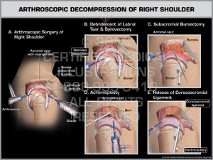 Exhibit of Arthroscopic Decompression of Right Shoulder.