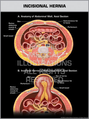 Exhibit of Incisional Hernia. Exhibit of Incisional Hernia.