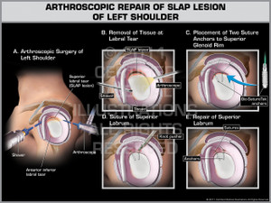 Exhibit of Arthroscopic Repair of Slap Lesion of Left Shoulder.