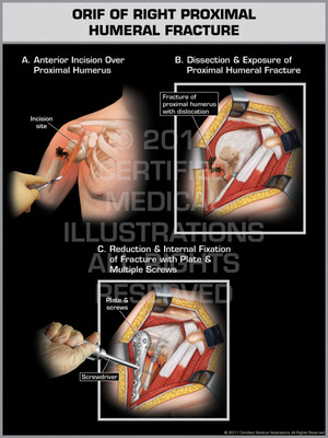 Exhibit of ORIF of Right Proximal Humeral Fracture.
