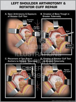 Exhibit of Left Shoulder Arthrotomy & Rotator Cuff Repair.