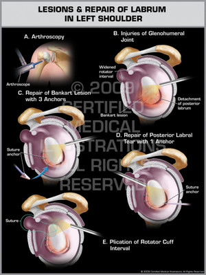 Exhibit of Lesions & Repair of Labrum in Left Shoulder.