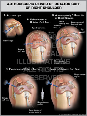 Exhibit of Arthroscopic Repair of Rotator Cuff of Right Shoulder. Exhibit of Arthroscopic Repair of Rotator Cuff of Right Shoulder.