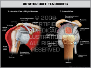 Exhibit of Rotator Cuff Tendonitis - Right.