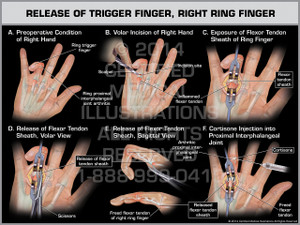 Exhibit of Release of Trigger Finger, Right Ring Finger. Exhibit of Release of Trigger Finger, Right Ring Finger.