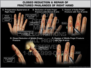 Exhibit of Closed Reduction & Repair of Fractured Phalanges of Right Hand.
