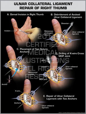 Exhibit of Ulnar Collateral Ligament Repair of Right Thumb. Exhibit of Ulnar Collateral Ligament Repair of Right Thumb.