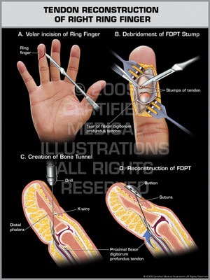 Exhibit of Tendon Reconstruction of Right Ring Finger. Exhibit of Tendon Reconstruction of Right Ring Finger.