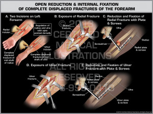 Open Reduction & Internal Fixation of Complete Displaced Fractures of the Forearm