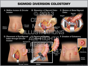 Exhibit of Sigmoid Diversion Colostomy (Female).