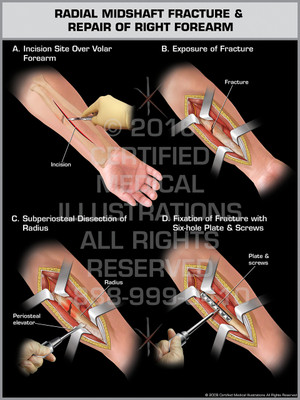 Radial Midshaft Fracture & Repair of Right Forearm Radial Midshaft Fracture & Repair of Right Forearm