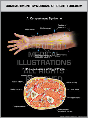 Compartment Syndrome of Right Forearm