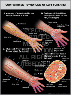 Compartment Syndrome of Left Forearm 1 Compartment Syndrome of Left Forearm 1