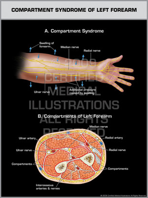 Compartment Syndrome of Left Forearm Compartment Syndrome of Left Forearm
