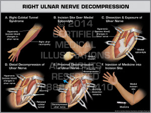 Right Ulnar Nerve Decompression Right Ulnar Nerve Decompression