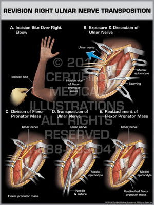 Revision Right Ulnar Nerve Transposition Revision Right Ulnar Nerve Transposition