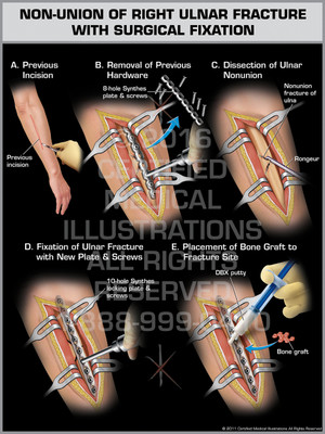 Non-Union of Right Ulnar Fracture with Surgical Fixation Non-Union of Right Ulnar Fracture with Surgical Fixation