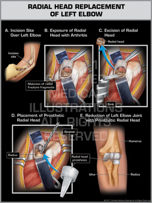 Radial Head Replacement of Left Elbow