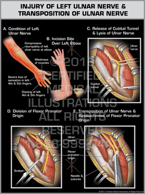 Injury of Left Ulnar Nerve & Transposition of Ulnar Nerve Injury of Left Ulnar Nerve & Transposition of Ulnar Nerve