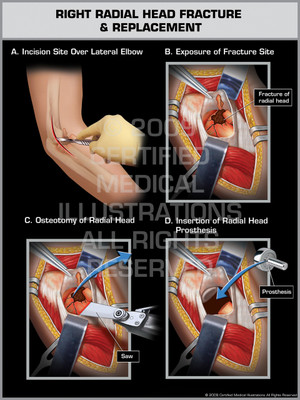 Right Radial Head Fracture & Replacement Right Radial Head Fracture & Replacement