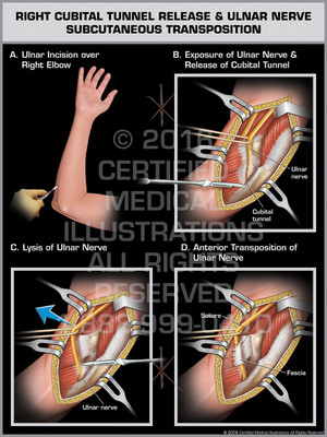 Exhibit of Right Cubital Tunnel Release & Ulnar Nerve Subcutaneous Transposition. Exhibit of Right Cubital Tunnel Release & Ulnar Nerve Subcutaneous Transposition.