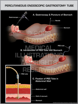Percutaneous Endoscopic Gastrostomy Tube Percutaneous Endoscopic Gastrostomy Tube