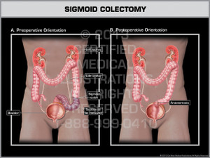 Exhibit of Sigmoid Colectomy.