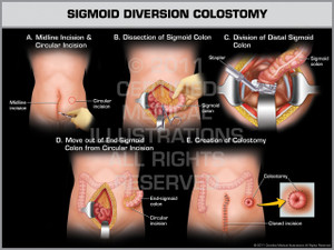 Exhibit of Sigmoid Diversion Colostomy (Male). Exhibit of Sigmoid Diversion Colostomy (Male).
