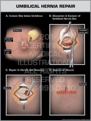 Umbilical Hernia Repair