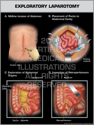 Exhibit of Exploratory Laparotomy. Exhibit of Exploratory Laparotomy.