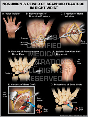 Exhibits of Nonunion & Repair of Scaphoid Fracture in Right Wrist Exhibits of Nonunion & Repair of Scaphoid Fracture in Right Wrist