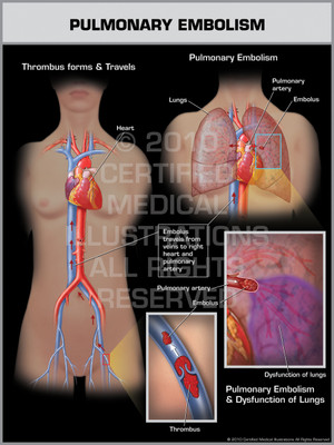 Pulmonary Embolism Female