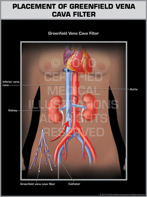 Placement of Greenfield Vena Cava Filter Female Placement of Greenfield Vena Cava Filter Female